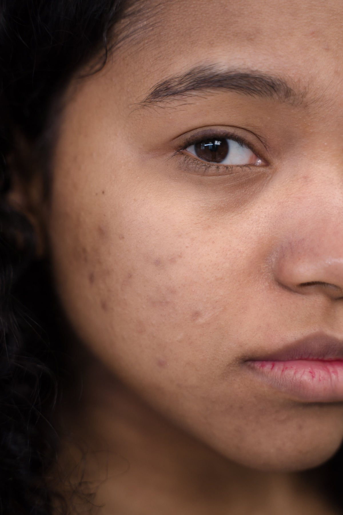 Stress Breakouts Are Real: The Cortisol-Skin Connection